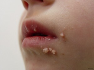 Если появились бородавки