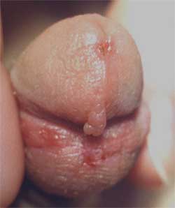 Проблемы половой системы мальчиков